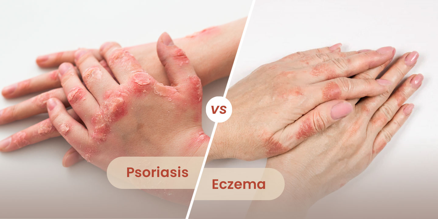 Psoriasis vs. Eczema: Symptoms, Causes, and Treatment - Cure Natural Skin  Care